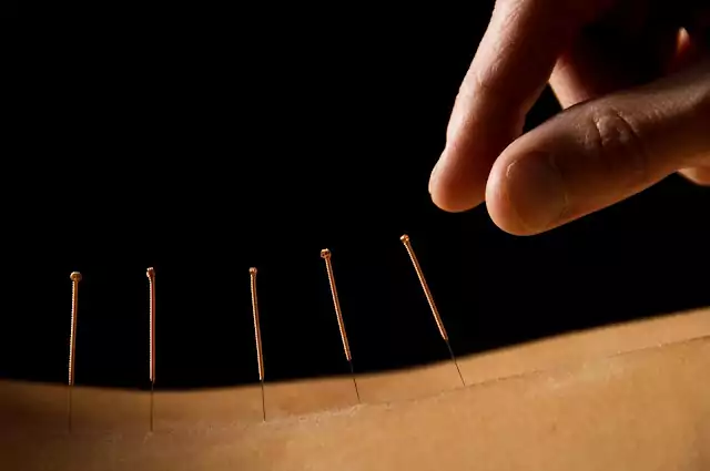 acupuncture